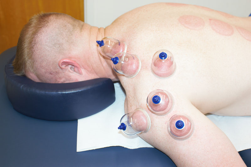 Cupping in Chippenham